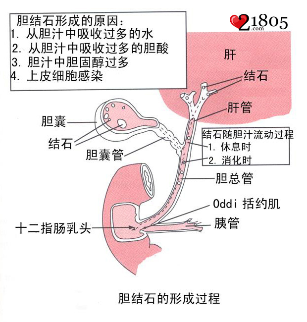 爱吃甜食易患胆结石